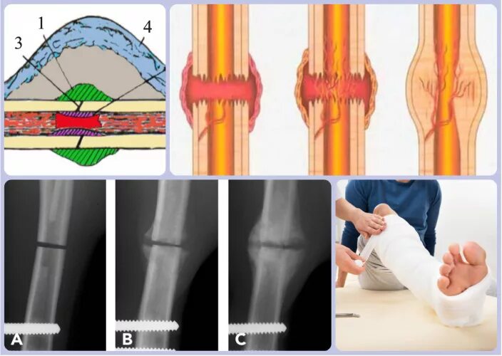 Почему болит кость после перелома. Костная мозоль при переломе.берцовой кости. Муфтообразная костная мозоль. Параоссальная костная мозоль. Сращение перелома костная мозоль.