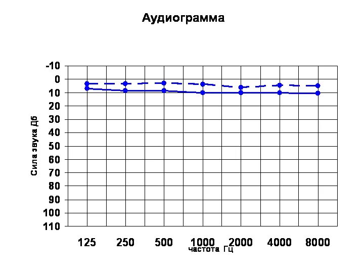 Аудиограмма степени. Тональная пороговая аудиограмма норма. Тональная пороговая аудиометрия норма. Аудиограмма слуха здорового человека. Аудиограмма при нормальном слухе.