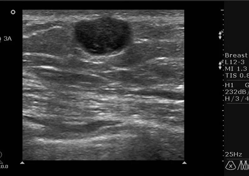 Кистозный солидный образование молочные железа. Гипоэхогенные образования в почках на УЗИ. Гипоэхогенное образование в молочной железе на УЗИ. Гипоэхогенное образование мягких тканей на УЗИ. Гипоэхогенное Солидное образование УЗИ.