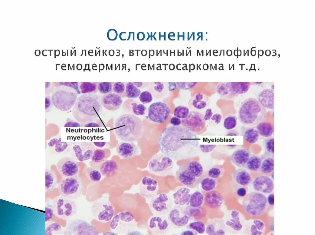 Миелобластный лейкоз осложнения. Осложнения при острых лейкозах. Осложнения лейкоза у детей. Осложнения острого лейкоза