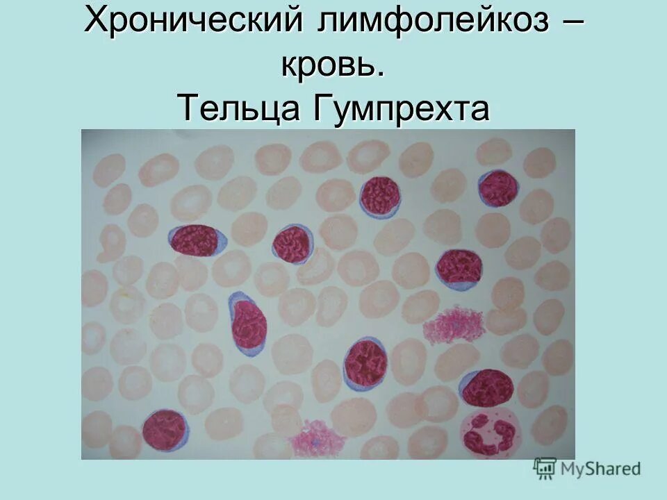 клетки боткина гумпрехта выявляются при