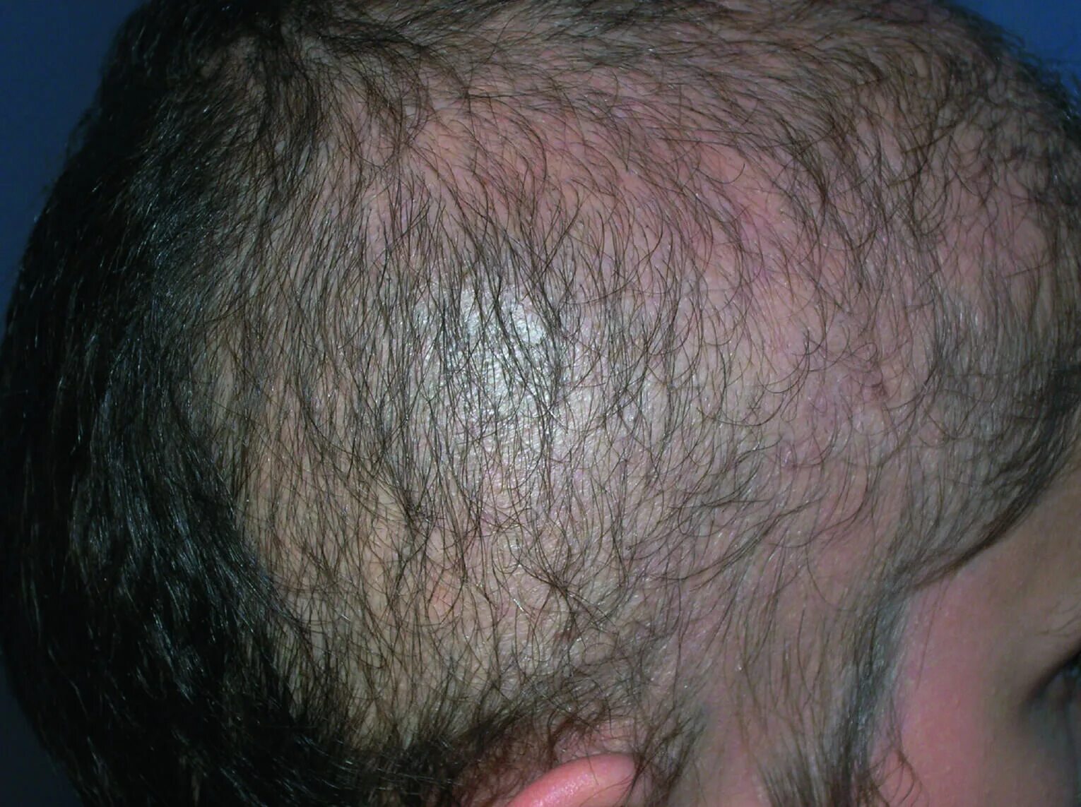 Трихофития волосистой части головы. Можно выдрать волосы