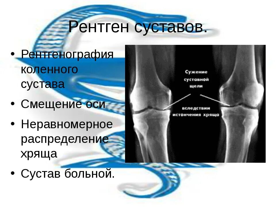 Коленный сустав по стадиям. Расшифровка рентгена коленного сустава. Рентген нормального коленного сустава. Нормальная рентгенограмма коленного сустава. Коленный сустав рентген норма.