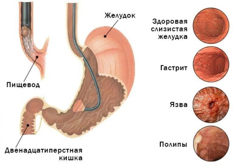 Двенадцатиперстная кишка ФГДС. ФГДС при язвенной болезни желудка. Гастродуоденальные кровотечения ФГДС. ЭГДС хронический гастрит. Надо пищевода