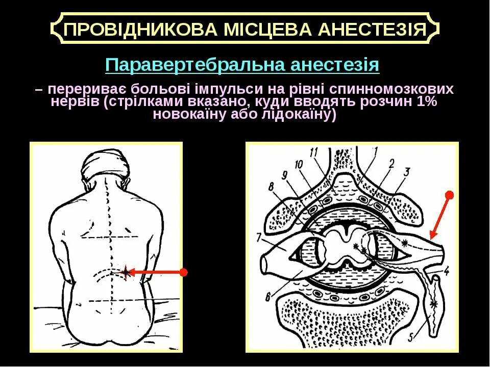 Сегментарная паравертебральная новокаиновая блокада. Техника выполнения паравертебральной блокады. Паравертебральная блокада методика. Паравертебральная блокада пояснично-крестцовый техника выполнения.