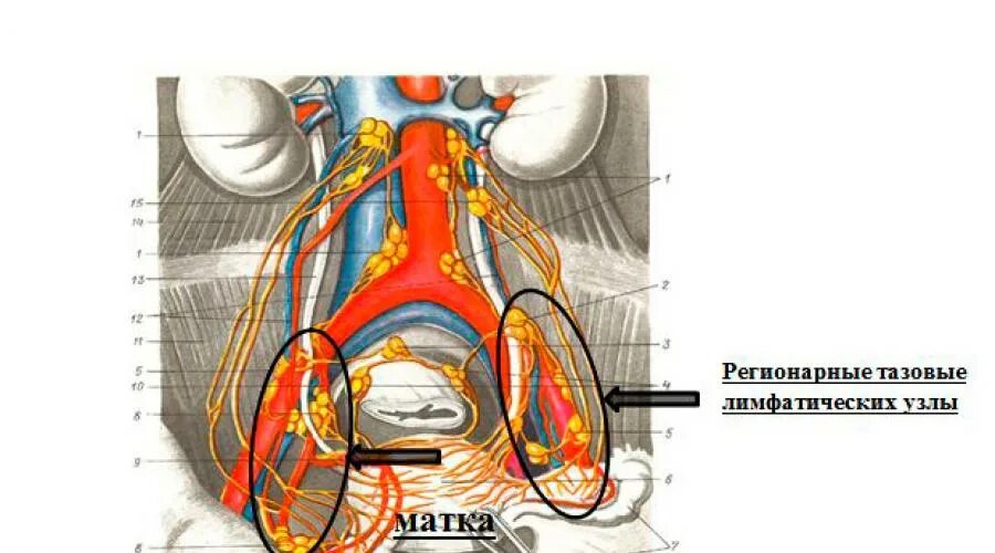 Лимфоузлы и удаление матки. Регионарные лимфатические узлы малого таза. Регионарные лимфатические узлы матки. Регионарные лимфатические узлы шейки матки. Тазовые лимфатические узлы.