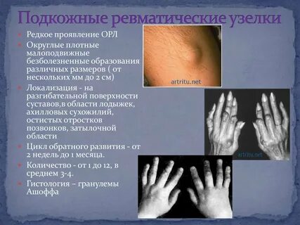 Ревматическая лихорадка презентация