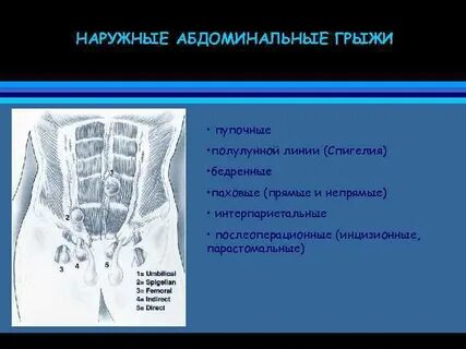 Грыжа линии
