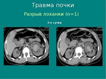 Почечный разрыв