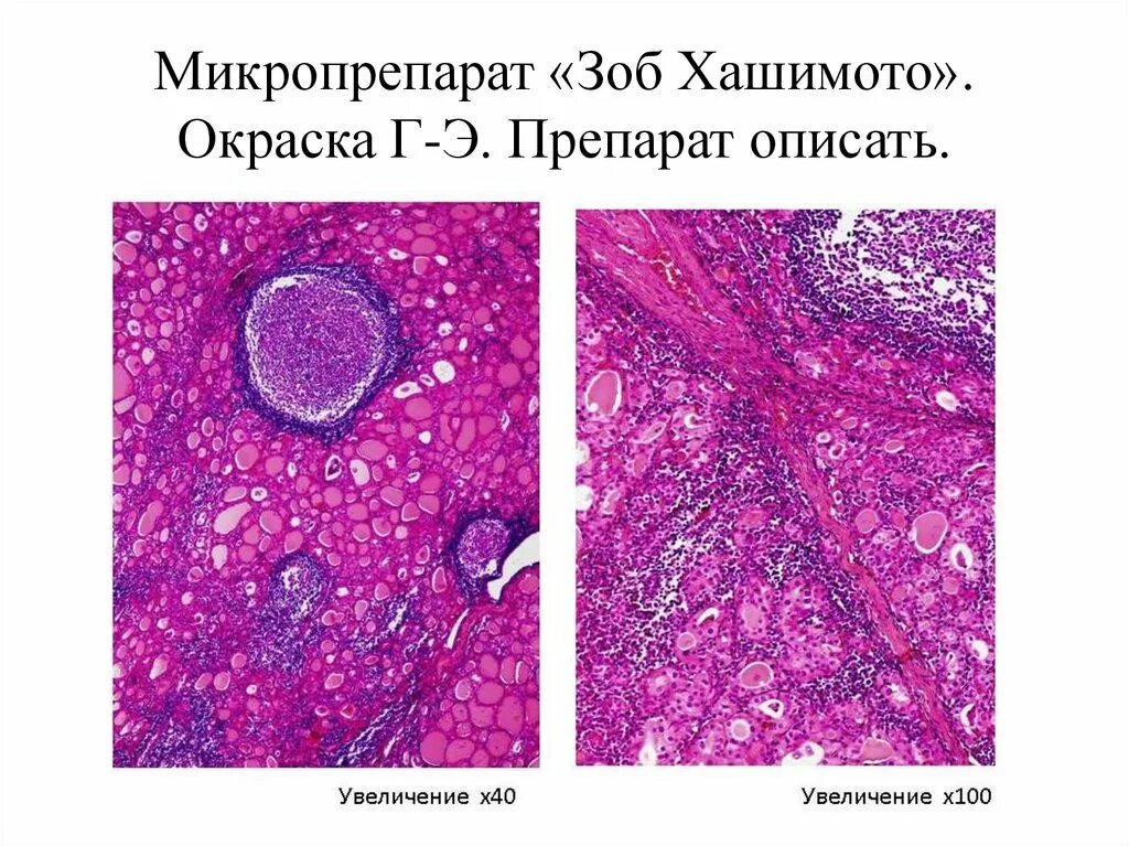 Аутоиммунный зоб. Зоб Хашимото микропрепарат патанатомия. Аутоиммунный тиреоидит зоб Хашимото микропрепарат. Болезнь Хашимото гистология. Хронический тиреоидит микропрепарат.