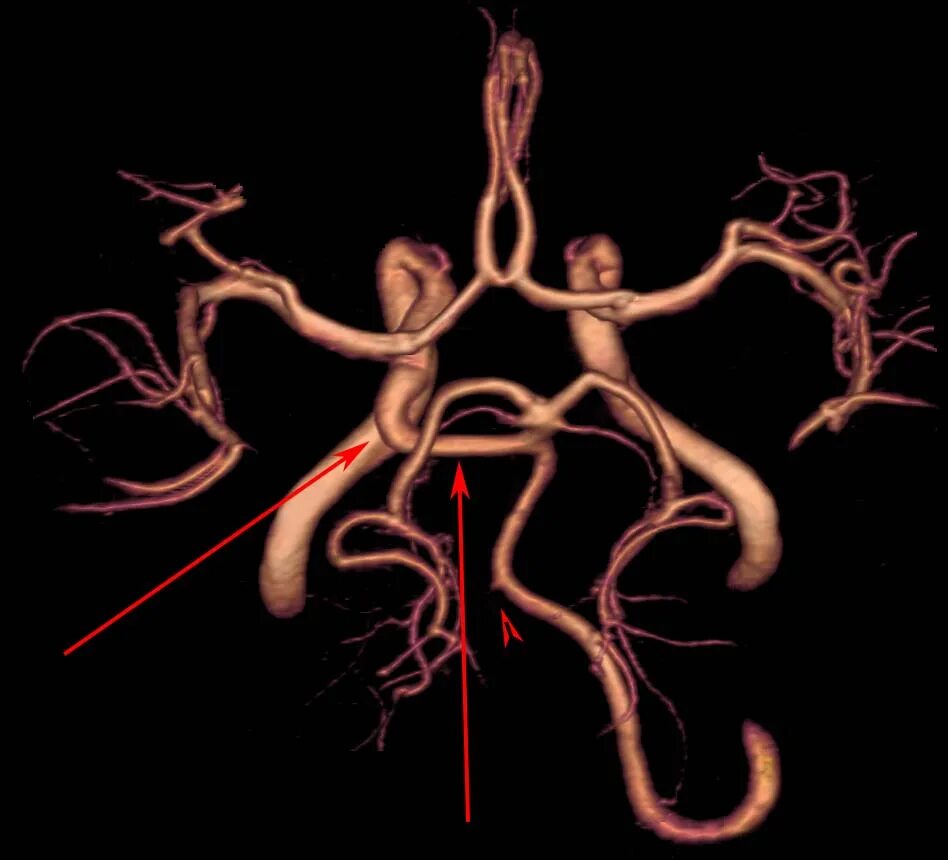 Интракраниальные артерии головного мозга. Кт ангиография сосудов головного мозга. Кт ангиография сосудов головного мозга анатомия. Ангиография интракраниальных артерий головного мозга. Мрт ангиография интракраниальных сосудов.