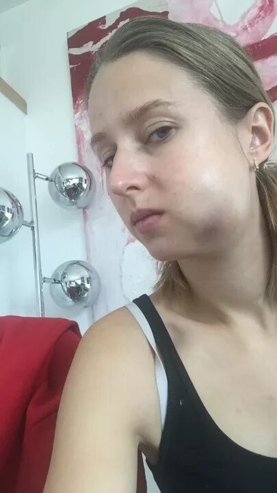 Wisdom tooth extraction - consequences and complications