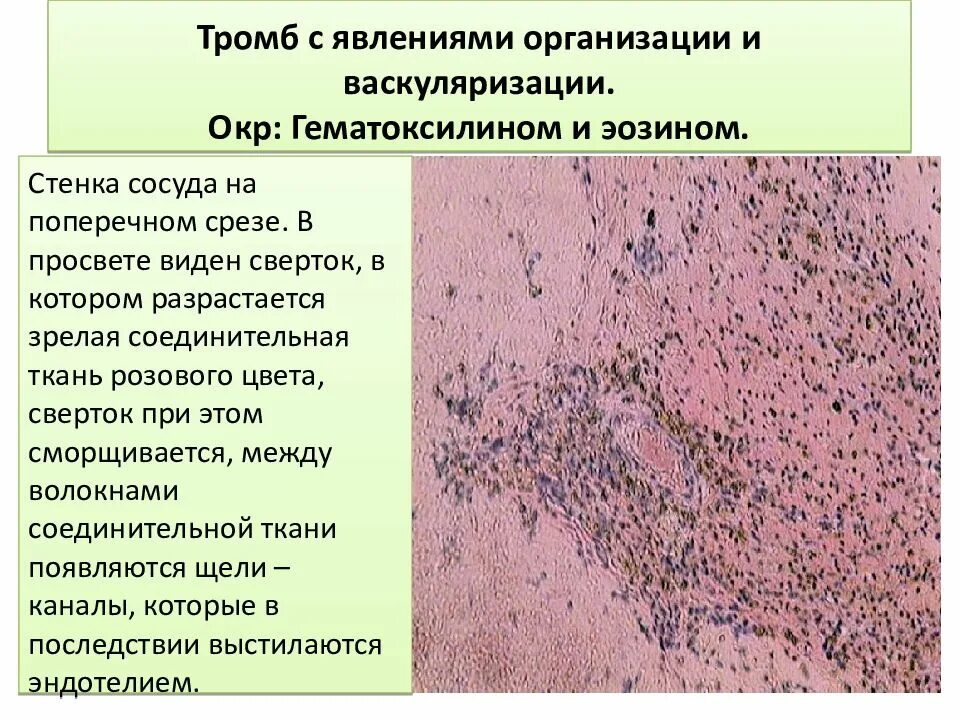 Смешанный тромб. Смешанный тромб с явлениями организации. Тромб с явлениями организации микропрепарат. Организованный тромб с васкуляризацией.