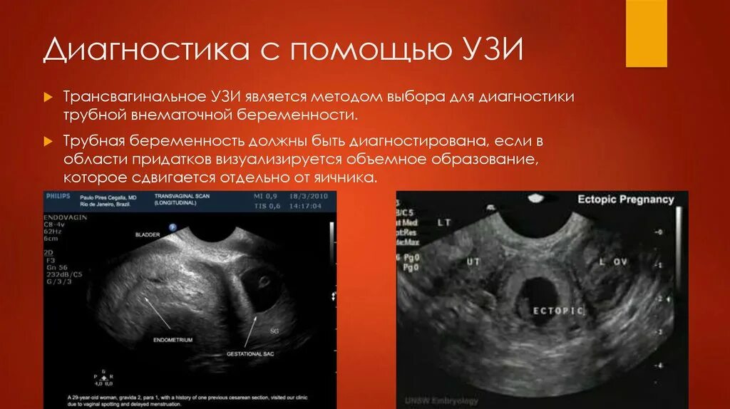 Диагноз внематочная беременность. Трубная беременность УЗИ. Методы диагностики трубной беременности. Диагностика внематочной беременности. Внематочная беременность УЗИ Трансвагинал.