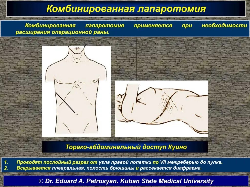 Лапаротомия что это такое простыми словами. Комбинированная лапаротомия. Разрезы при лапаротомии.