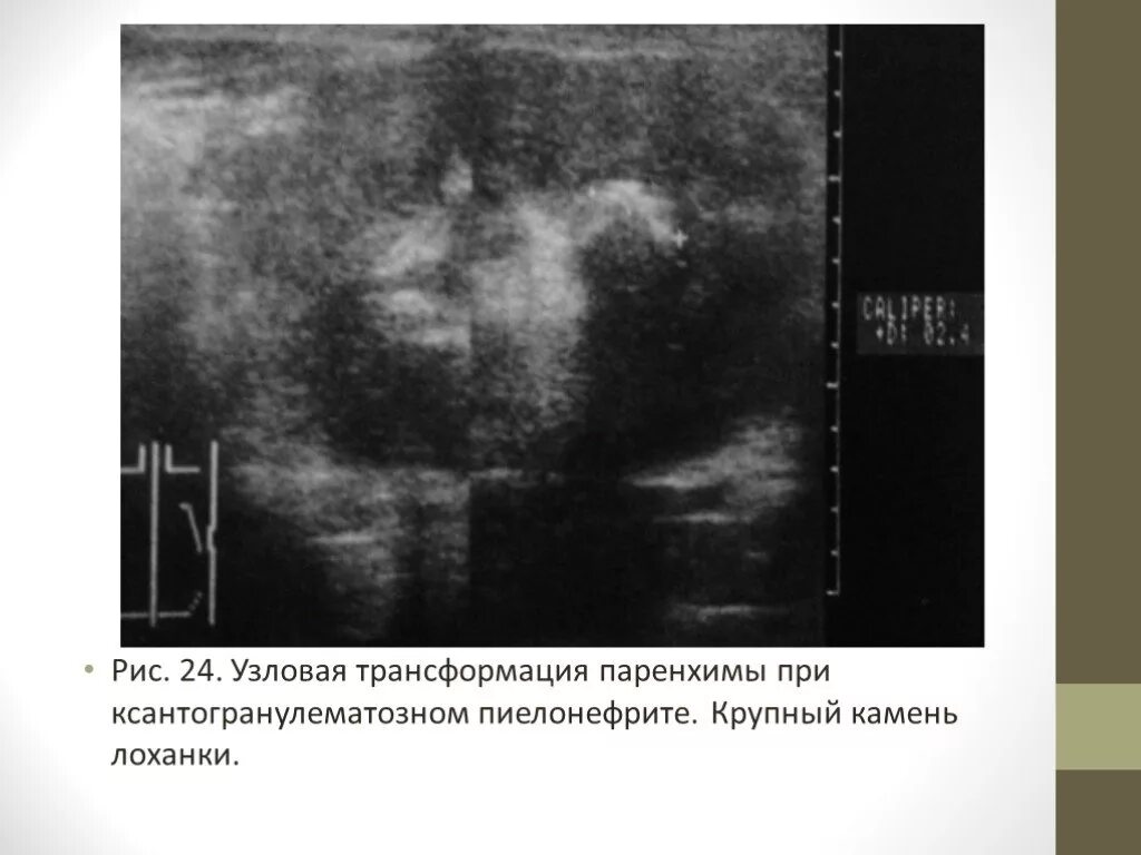 Узи лоханки почки. Ксантогранулематозный пиелонефрит УЗИ. УЗИ критерии хронического пиелонефрита. Ксантогранулематозный пиелонефрит при УЗИ. Ксантогранулематозный пиелонефрит МСКТ.