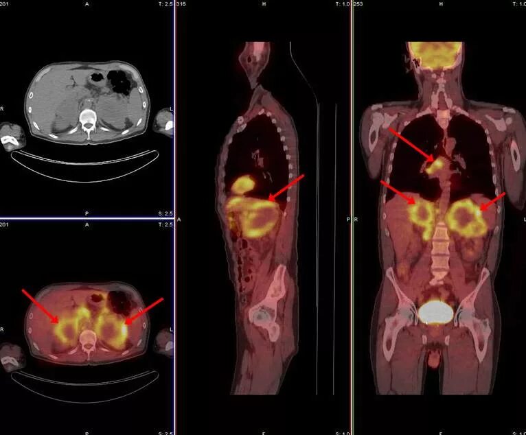 Pet ct. Позитрон-эмиссионная томография. Позитронно-эмиссионная томография (ПЭТ). Позитронно эмиссионная томография онкология. ПЭТ кт снимки метастазы.