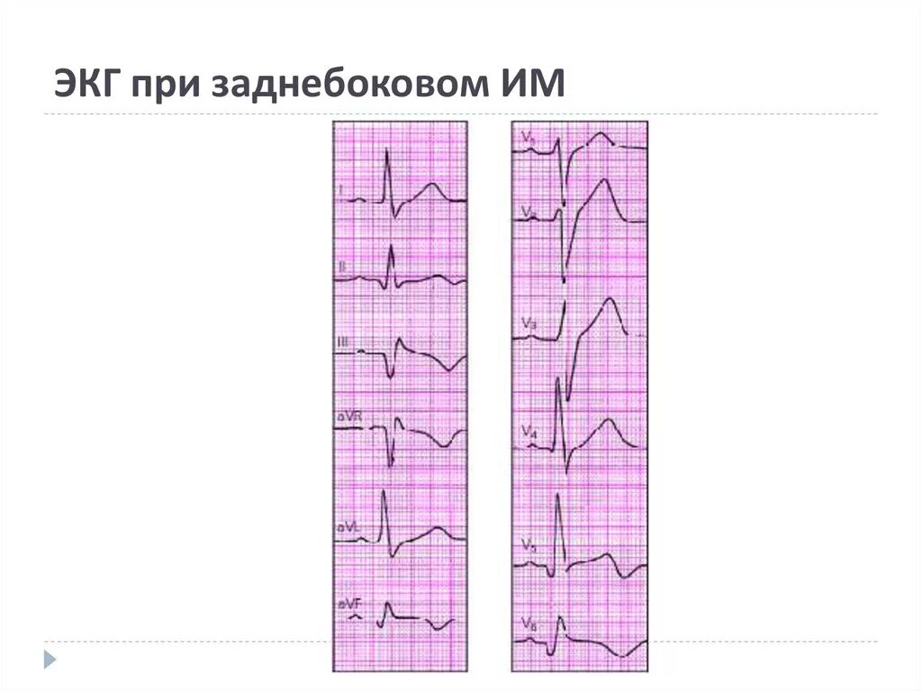 Гипотиреоз изменения на экг. Экг при ибс стенокардия напряжения. Изменения на экг при гипотиреозе. Изменения на экг при гипертиреозе. Тиреотоксикоз экг признаки.