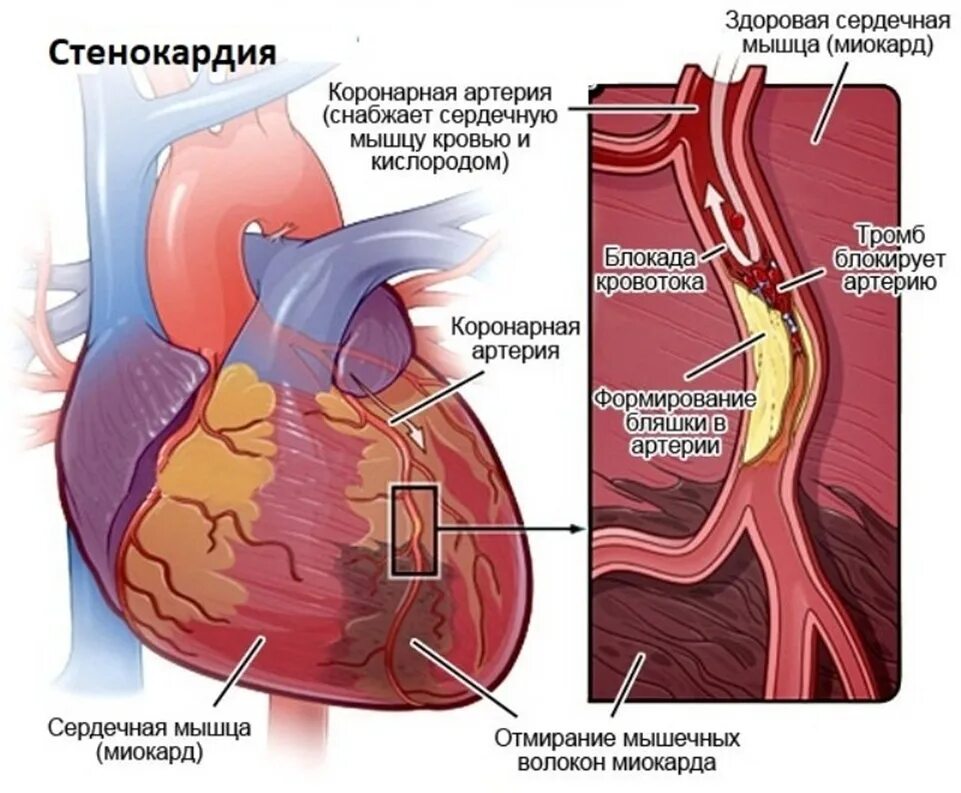 Ишемия боковой стенки. Ишемическая болезнь сердца стенокардия инфаркт миокарда. ИБС относится стенокардия, инфаркт миокарда. ИБС сердца и стенокардию. STENAKORDIA.