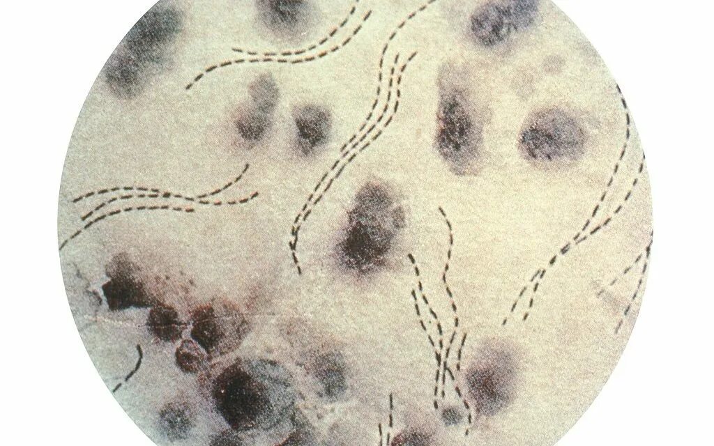 Haemophilus в мазке у мужчин. Фолликулярный шанкроид.