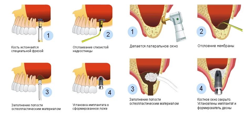Как определить имплантацию