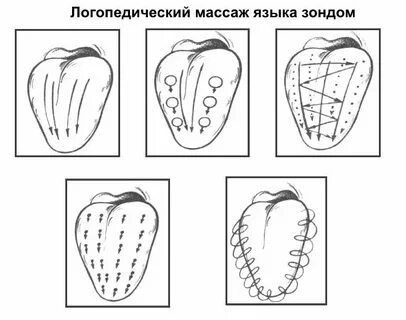 Постановка при дизартрии
