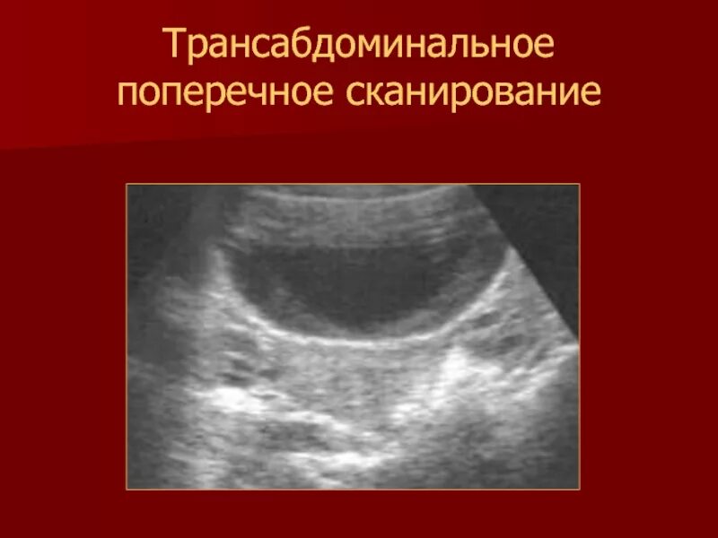 Трансабдоминальное узи. Яичники трансабдоминальное узи. трансабдоминальное исследование матки. ультразвуковое исследование матки и придатков трансабдоминальное. узи матки с придатками трансабдоминально.