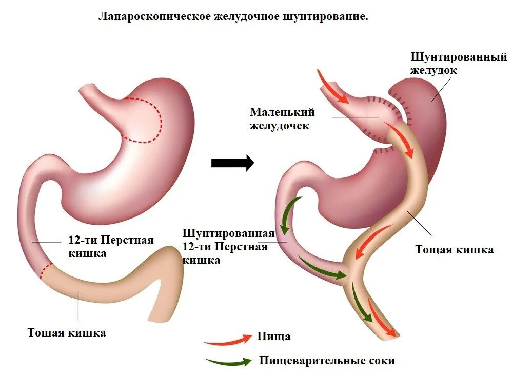 Резекция желудка махачкала. Бариатрия шунтирование желудка. шунтирование желудка схема. желудочное шунтирование схема операции. мини желудочное шунтирование.