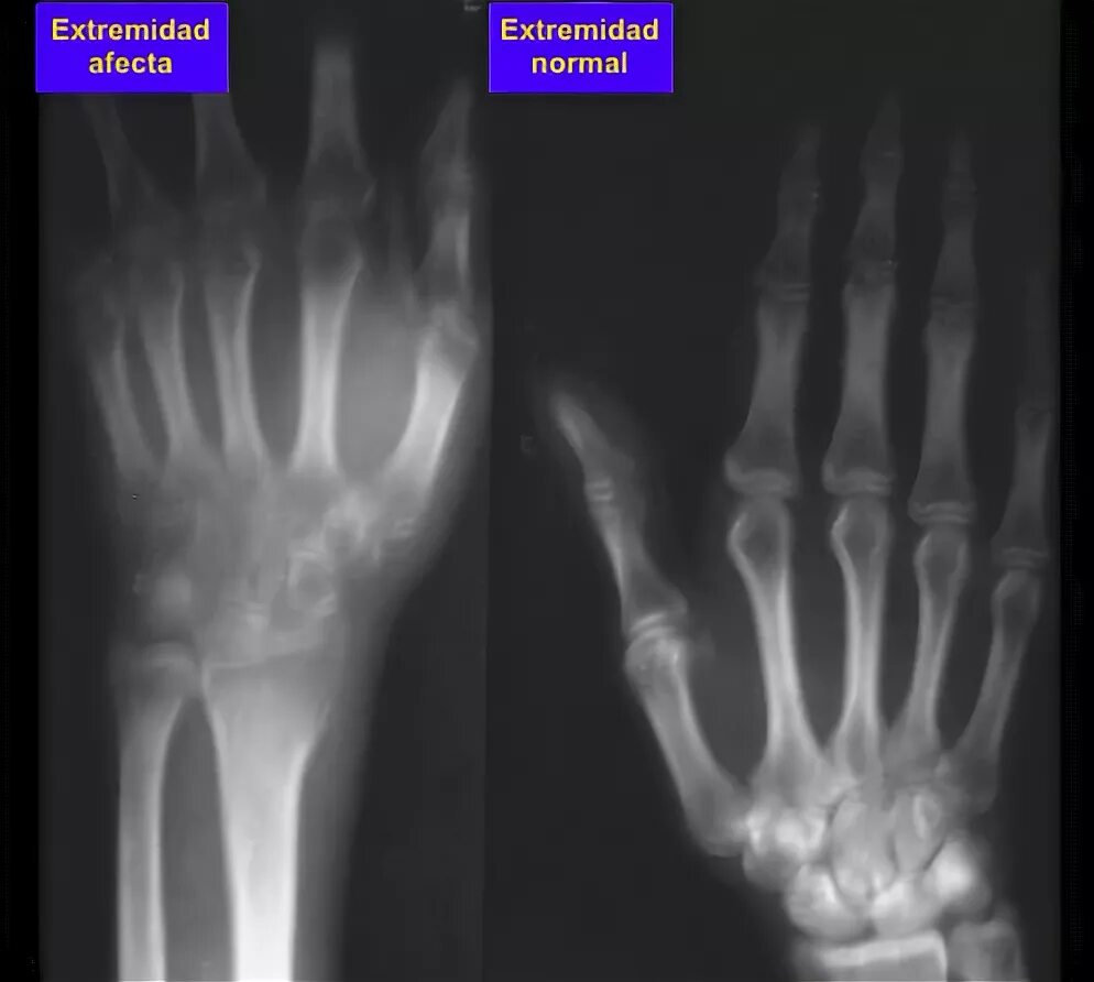 Синдром зудека рентген. Синдром зудека лучезапястного сустава. Ревматический полиартрит рентген. Полиартрит рентген кистей. Остеопороз зудека рентген.