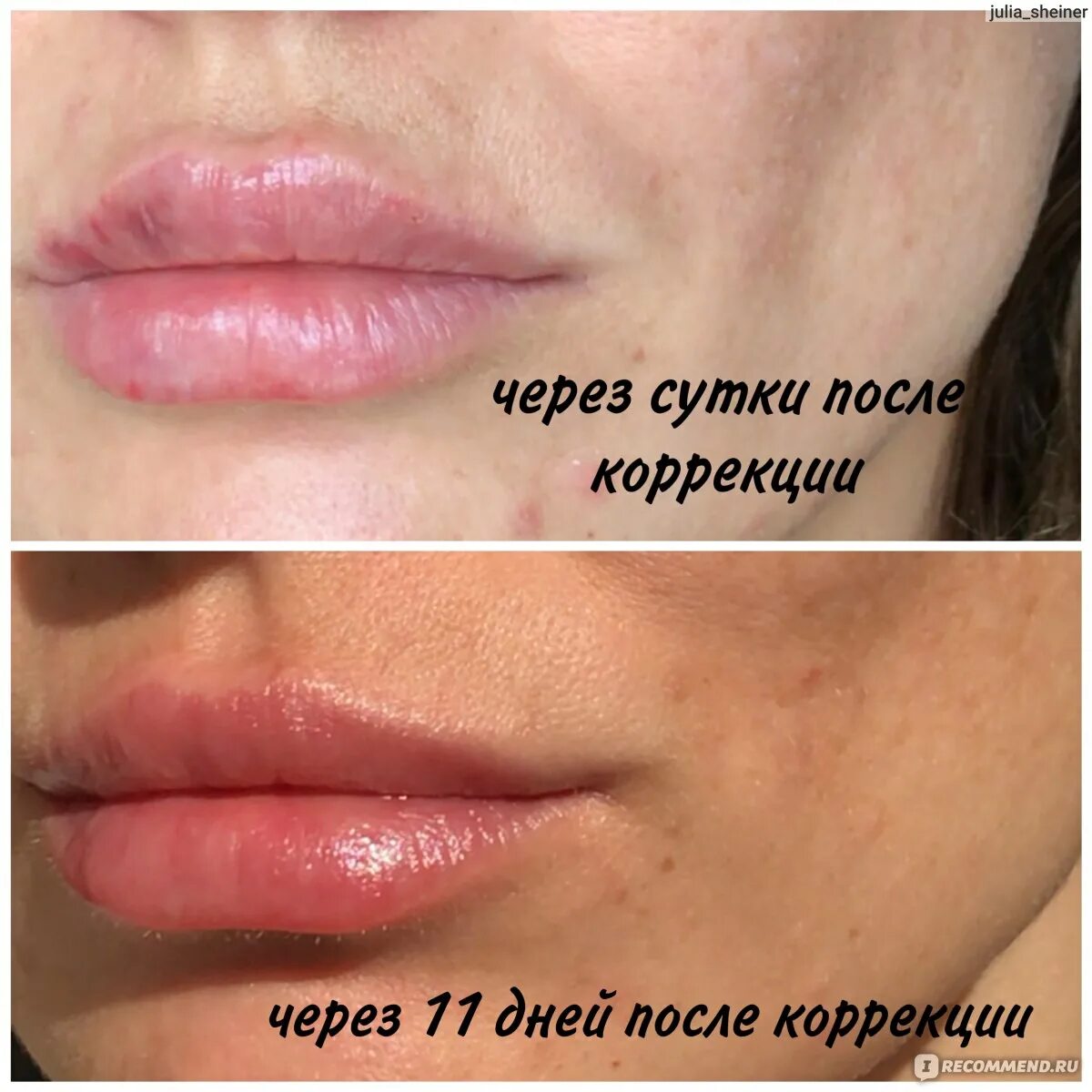 Увеличение губ сардиния. Увеличение губ сардиния. Увеличение губ гиалуроновой кислотой. Филлер deep для увеличения губ. Новая техника увеличения губ.