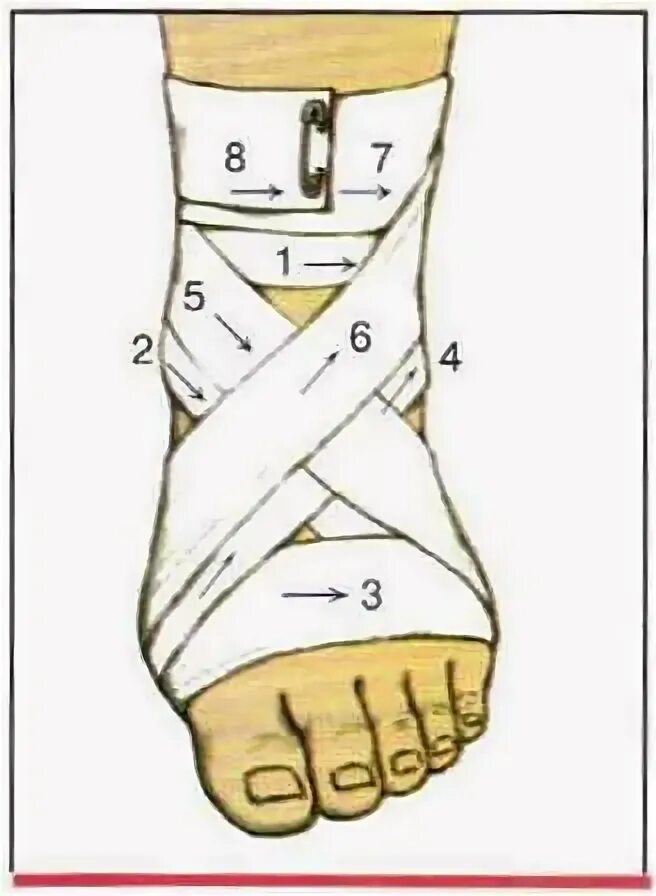 Алгоритм наложения крестообразной повязки на стопу. Крестообразная восьмиобразная повязка на стопу алгоритм. Наложение повязки на голеностопный сустав алгоритм. Бинтование голеностопа эластичным бинтом. Какая повязка при повреждении голеностопного сустава