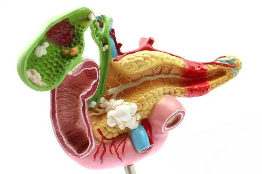Поджелудочная железа камни удаление. Желчекаменная болезнь холелитиаз. Острый панкреатит поджелудочной железы. Панкреатит и желчекаменная болезнь. Камни в желчном пузыре и поджелудочная железа.