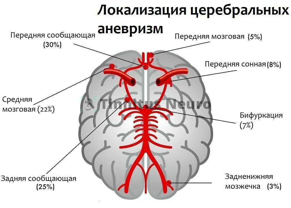 Аневризмы сосудов головного мозга локализация. Аневризма базилярной артерии головного мозга. Аневризма передней мозговой артерии головного. Аневризма сонной артерии классификация.