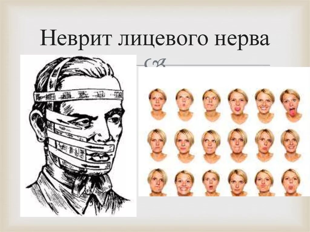 Реабилитация лицевого нерва. Неврит лицевого нерва. Неврит лицевого лицевого нерва. Повязка при неврите лицевого нерва. Реабилитация при неврите лицевого нерва.