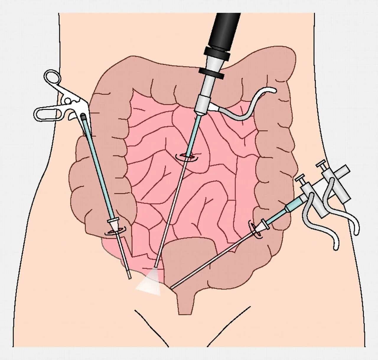 Операции через прямую кишку. Лапароскопическая аппендицит аппендэктомия. Лапароскопия и лапаротомия. Лапароскопическая аппендэктомия лапароскопия. Эндоскопическая аппендэктомия.