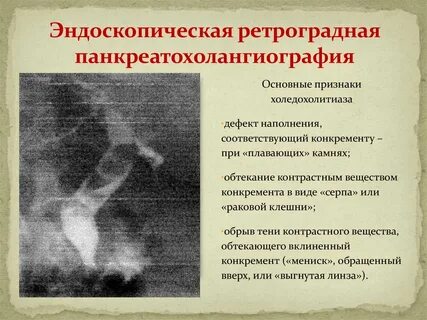Признаки холедохолитиаза