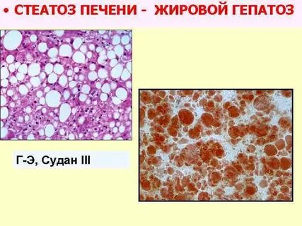 Диффузный стеатоз печени лечение