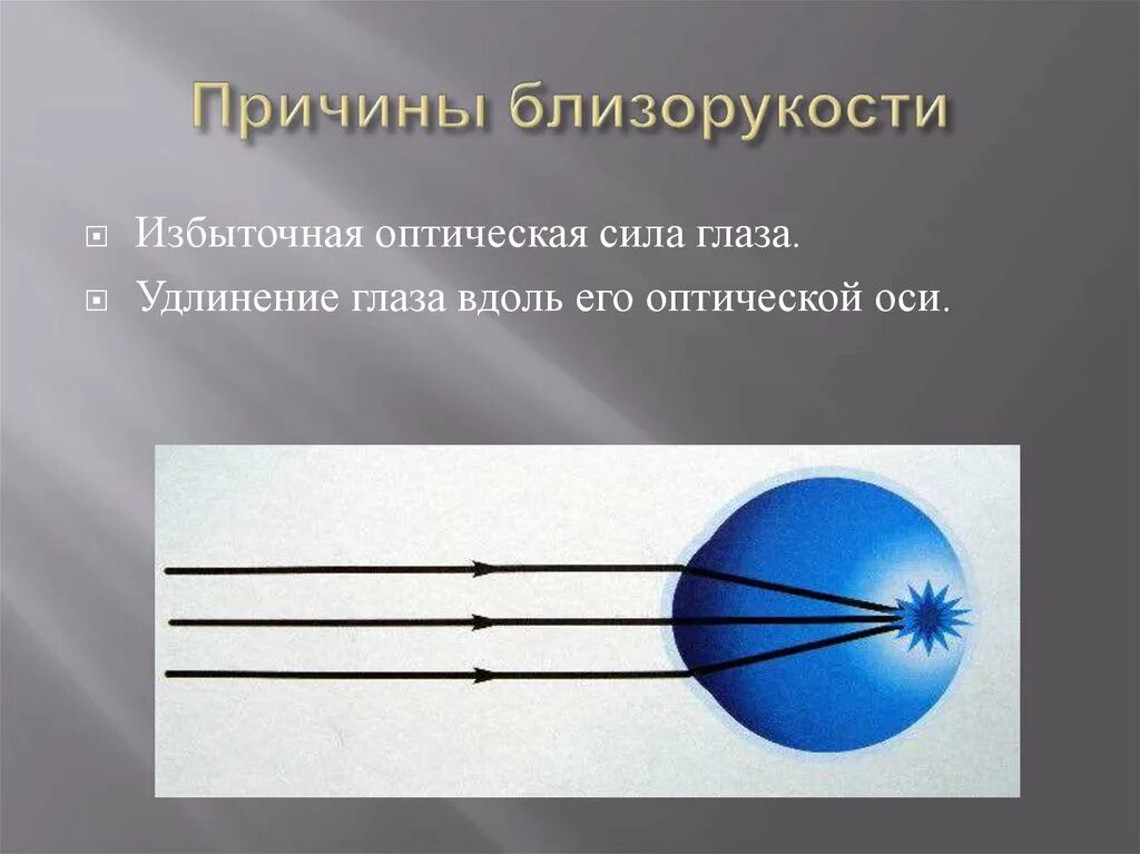 Причины близорукости. Причины возникновения близорукости. Причины возникновения миопии. Основные причины близорукости. Близорукость причины возникновения