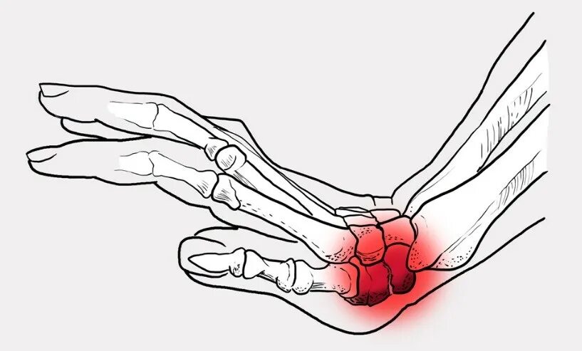 Перелом запястья болит