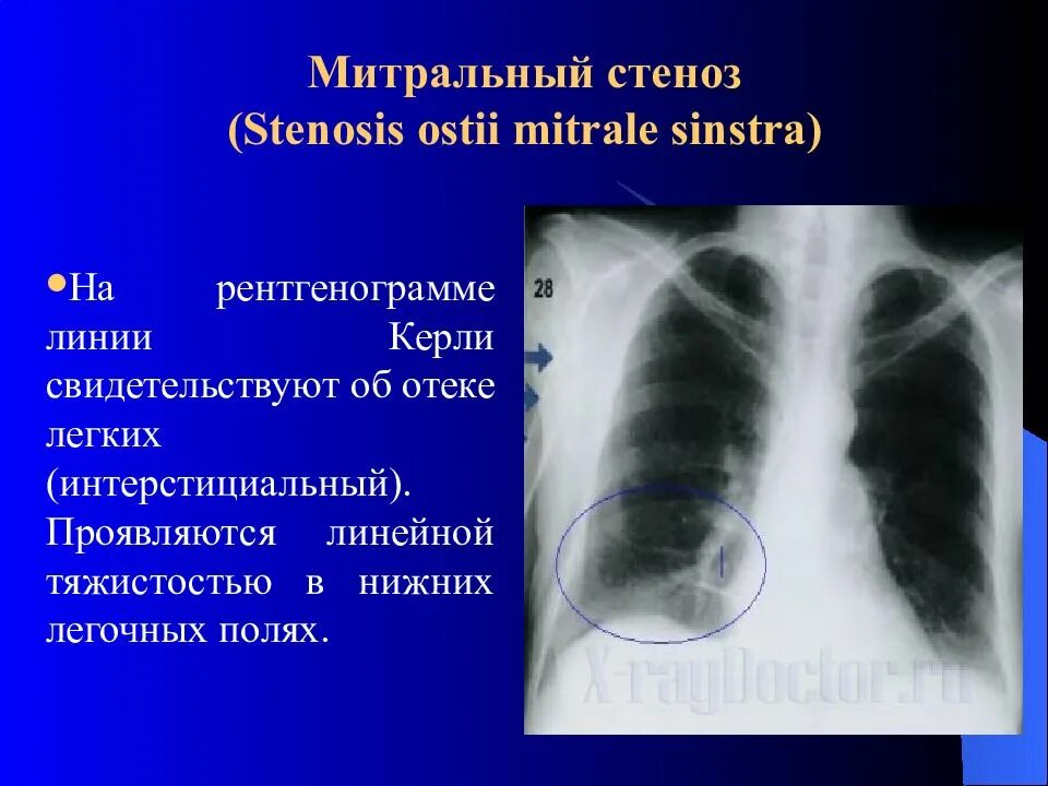 Митральный стеноз признаки. Линии Керли на рентгенограмме. Линии Керли на рентгенограмме в легком. Линии Керли в легких на рентгене. Перегородочные линии Керли.