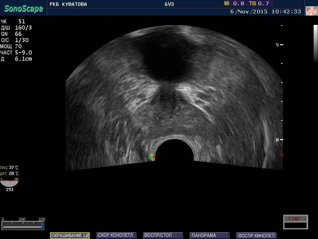 Простатит ру. Трансректальное УЗИ простаты. УЗИ трузи предстательной железы. Ультразвуковое исследование прямой кишки трансректальное (трузи). УЗИ предстательной железы трансректальным датчиком.