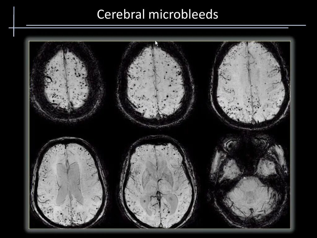 Церебральная микроангиопатия кт. Амилоидная микроангиопатия. Дегенеративная микроангиопатия. Микроангиопатия сосудов головного мозга мрт. Диффузная церебральная
