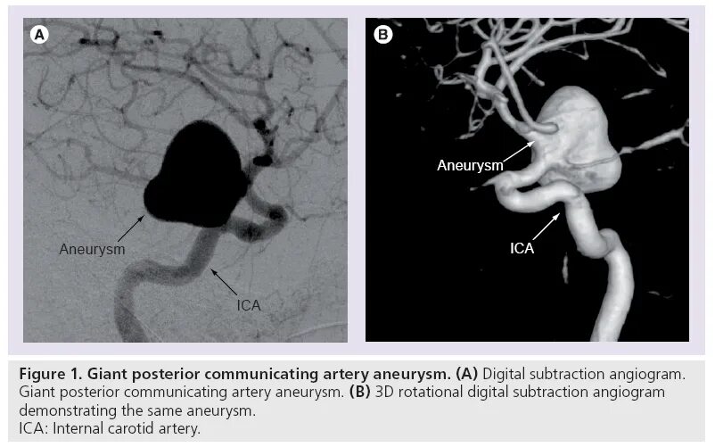 Aneurysm Nirvana. Нирвана альбом Aneurysm. Nirvana aneurysm