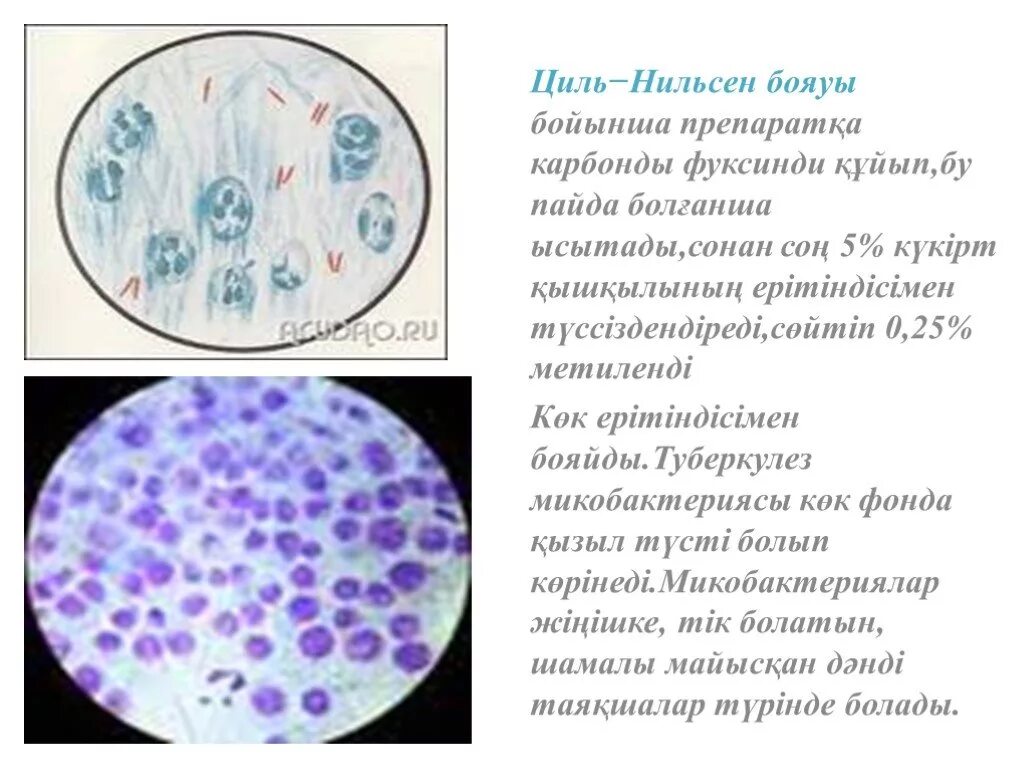Туберкулез циль нильсену. Микобактерии туберкулеза микроскопия мокроты. Микобактерии туберкулеза Циль Нильсен. Окраска по Цилю Нильсену препарат. Кислотоустойчивые бактерии по Цилю Нильсену.