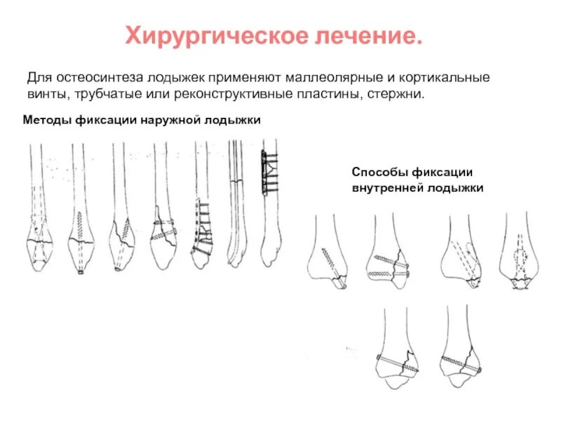 После остеосинтеза лодыжек. Методики остеосинтеза медиальной лодыжки. хирургические методы остеосинтеза. методы остеосинтеза при повреждении голеностопа. показания к остеосинтезу лодыжек.