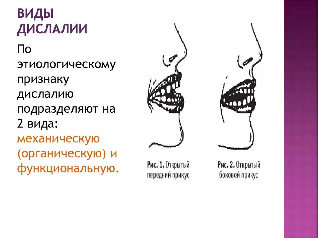 Формы функциональной дислалии. Причины функциональной дислалии. Механическая и функциональная дислалия. Формы дислалии схема. Артикуляционная дислалия