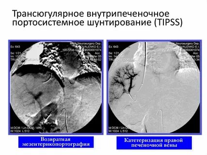 Синдром шунтирования печени