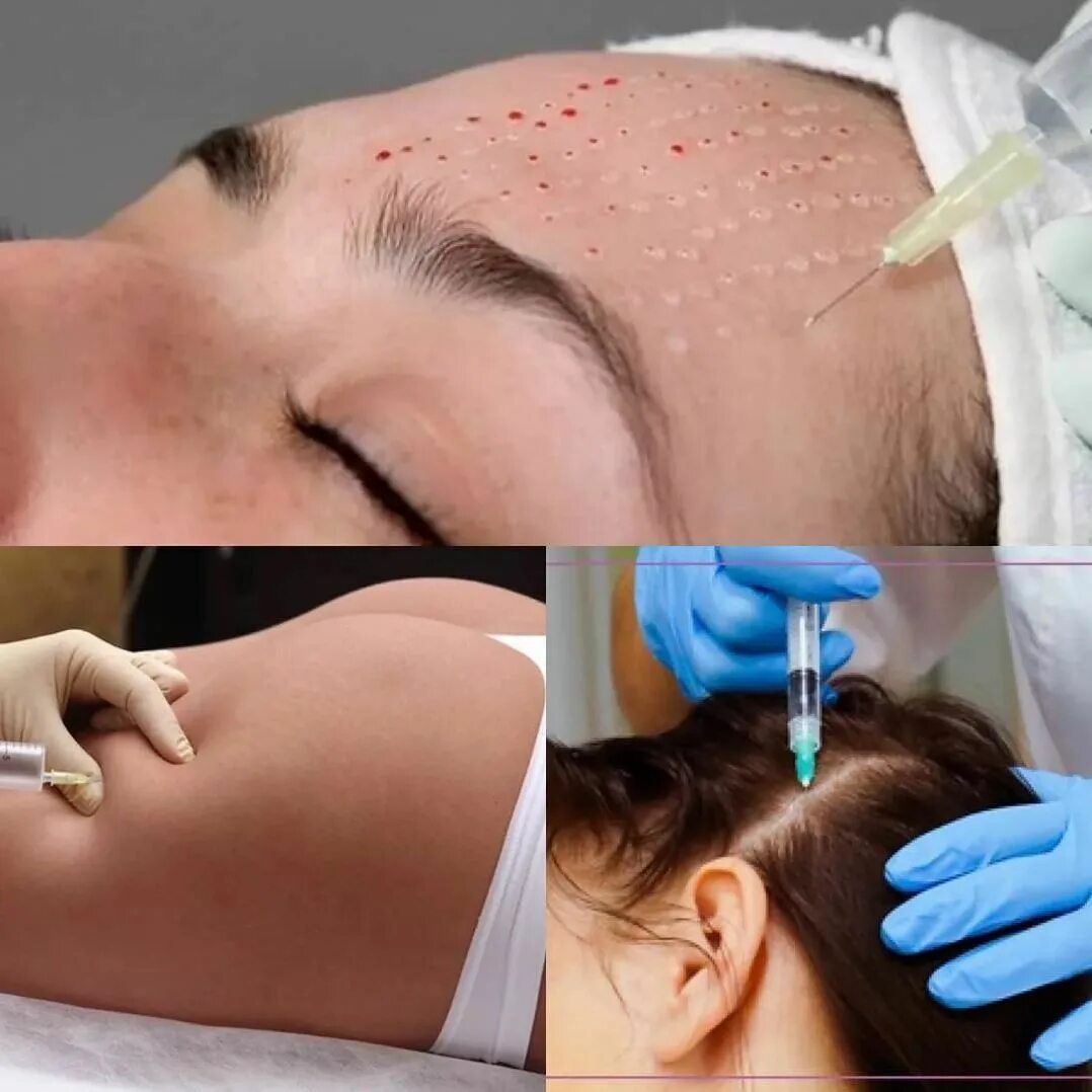 биорепарация. мезотерапия форум. техника наппаж мезотерапия. мезотерапия поверхностный наппаж. дмае мезотерапия.