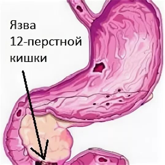 Как проявляется язва желудка симптомы. Язвенная болезнь 12-ти перстной кишки. язвенная болезнь 12-ти перстной кишки (дпк). симптомы язвы желудка и 12-перстной кишки.