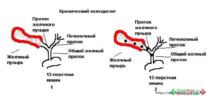 Желчный пузырь норма у мужчин. Этиопатогенез хронического холецистита. Желчный пузырь некалькулезный холецистит. Хронический калькулезный холецистит рисунок. Хронический калькулезный холецистит гистология.